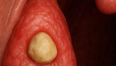 What are those ‘white stones’ that appear in the mouth and cause bad breath?