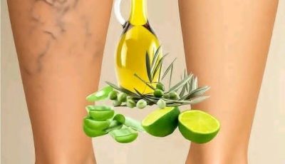 Grandmas Natural Remedy for Varicose Veins Aloe Vera Apple Cider Vinegar and Lemon