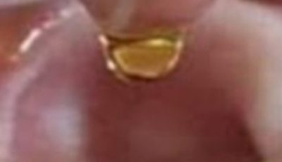 Put 2 drops in your ear and you will hear like before. Recover your hearing.