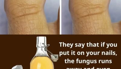 Home Remedy for Nail Fungus with Vinegar and Baking Soda