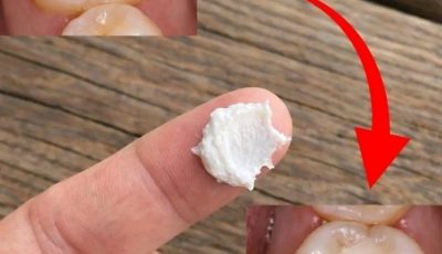 5 Simple Natural Home Remedies to Help Prevent Cavities and Support Healthy Teeth
