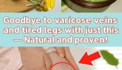 Aloe Vera: A Gentle Solution for Varicose Veins