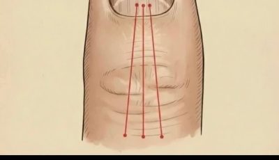 Lines on Your Fingernails: What They Might Reveal About Your Health