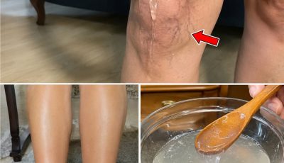 Aloe Vera Forces Relief Into Heavy Legs and Bulging Veins