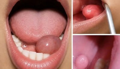 A Small Lump in the Mouth? Here Are the Early Symptoms You Shouldn’t Ignore