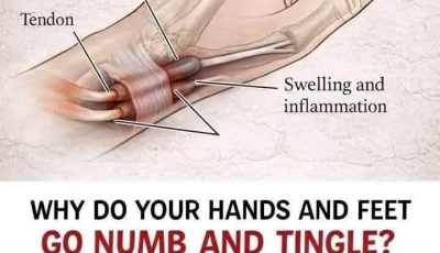 Why Do Your Hands Fall Asleep? Common Causes and Natural Remedies That Actually Work